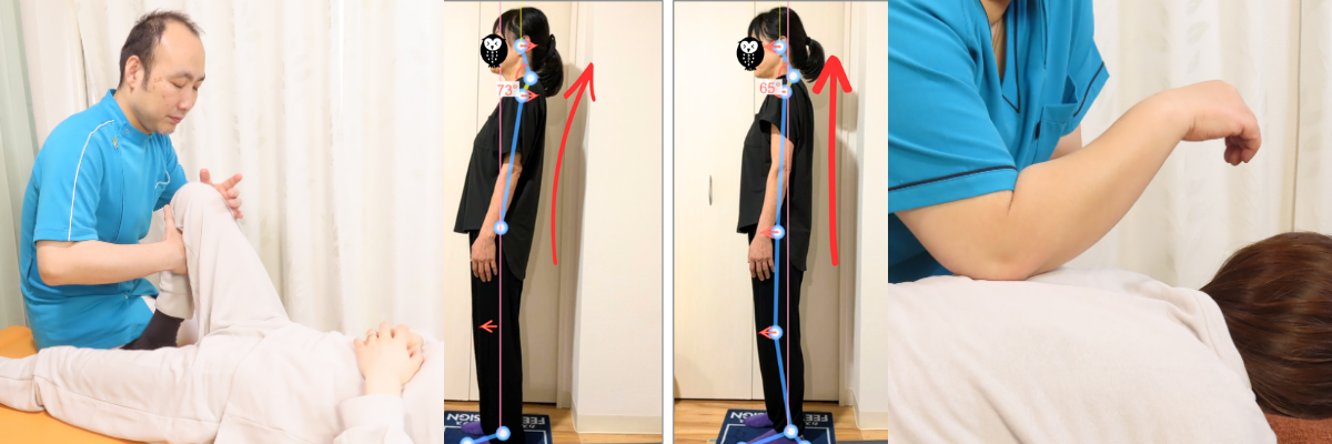 姿勢根本改善の施術